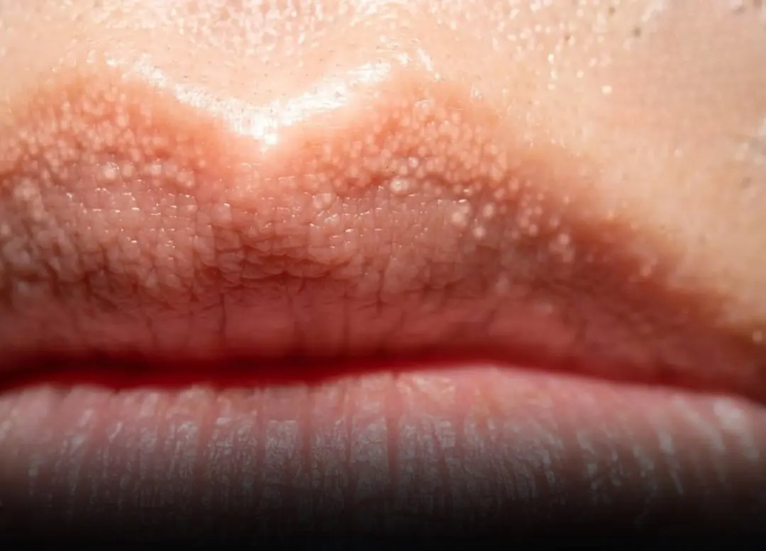 Warning: What Those Unusual White Bumps on Your Lips or Private Parts Could Mean