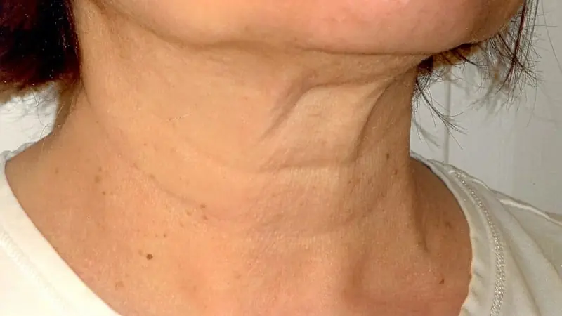 Tiny bumps on your neck? Don’t ignore them - here’s what to know