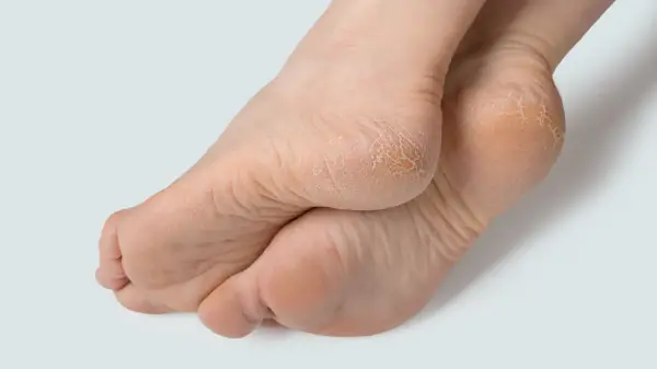 Dry skin isn’t the only reason for cracked heels - explore other possibilities