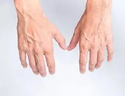 What Bulging Veins Could Reveal About Your Health