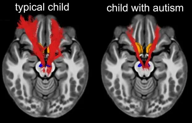 Scientists May Have Found a Clue — But the Truth About Autism Is More Complex Than You Think
