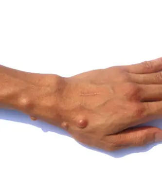 Sebaceous Cysts Explained: What Causes Them and How to Treat Them Naturally