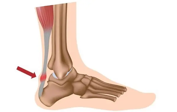 Why Do Your Legs Go Numb So Often? Understanding the Causes