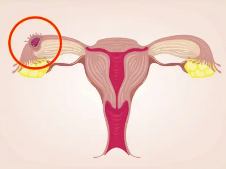 Women Who Frequently Eat These 5 Foods May Be Harming Their Uterus and Feeding Cancer Cells Without Knowing It