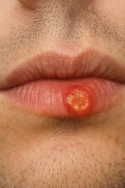 A Scab on Your Lip That Won’t Heal? It Might Be More Than Just a Minor Issue