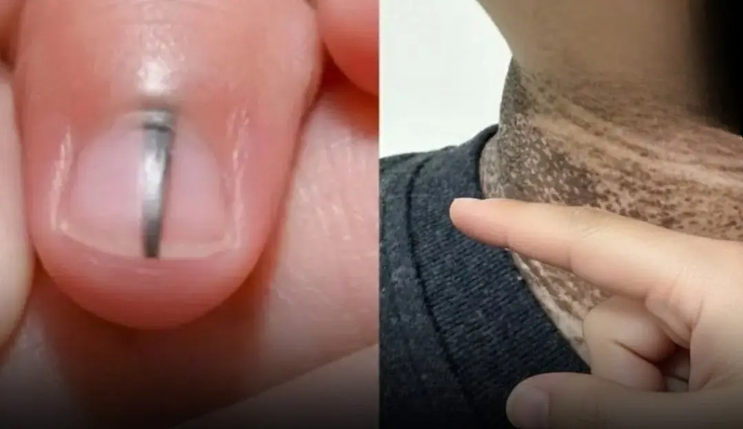 Five unusual dark patches on the body that may signal potential can.cer risk