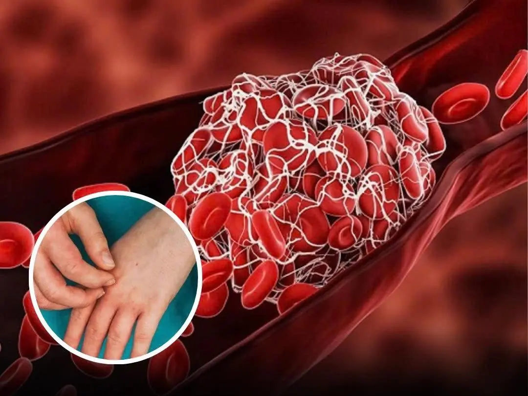 Could These 10 Symptoms Be Early Signs of Blo:od Can:cer?