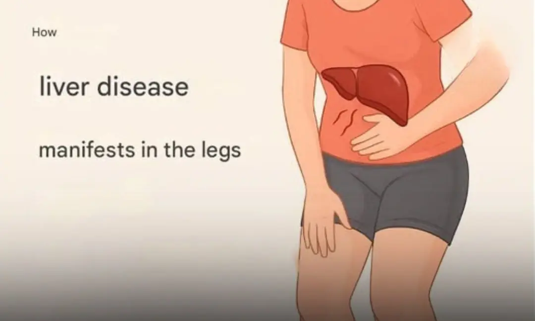 The Surprising Ways Liver Disease Appears on the Legs
