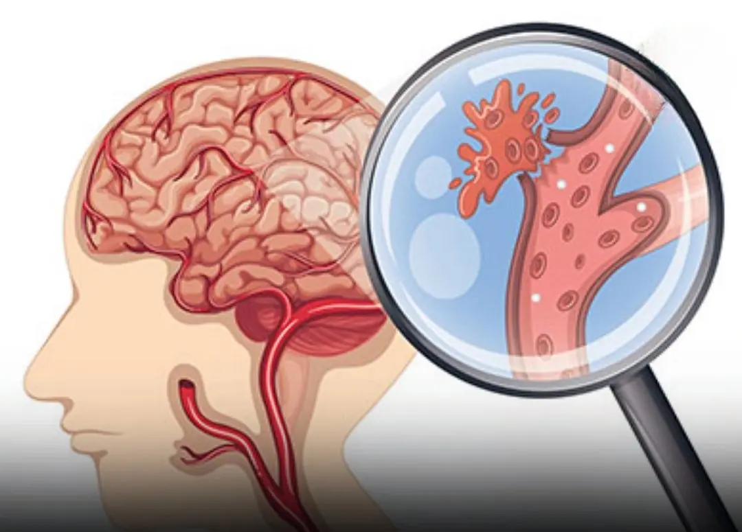 Recognizing an Aneurysm: The Dang:erous Symptoms That Demand Immediate Attention