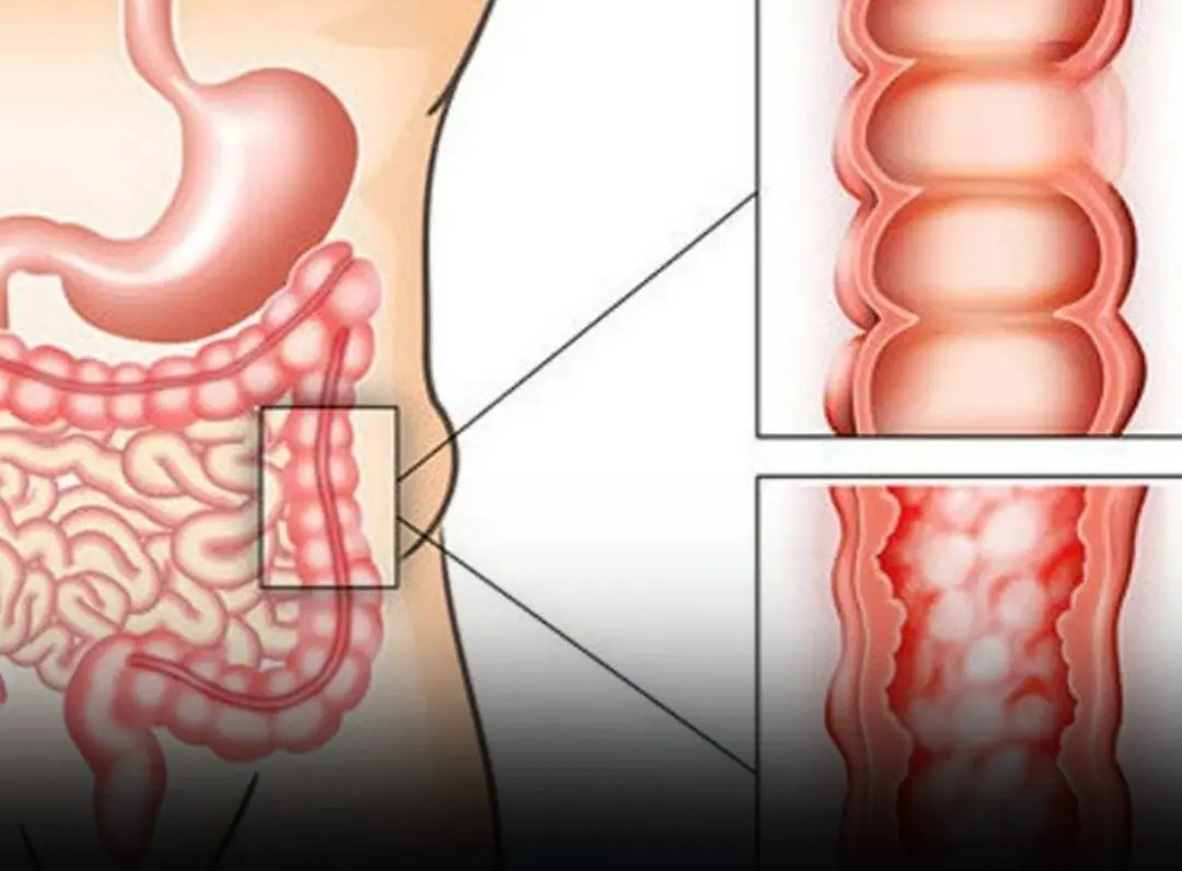 6 Subtle Signs of Stage 1 Colon Can:cer You Should Never Ignore