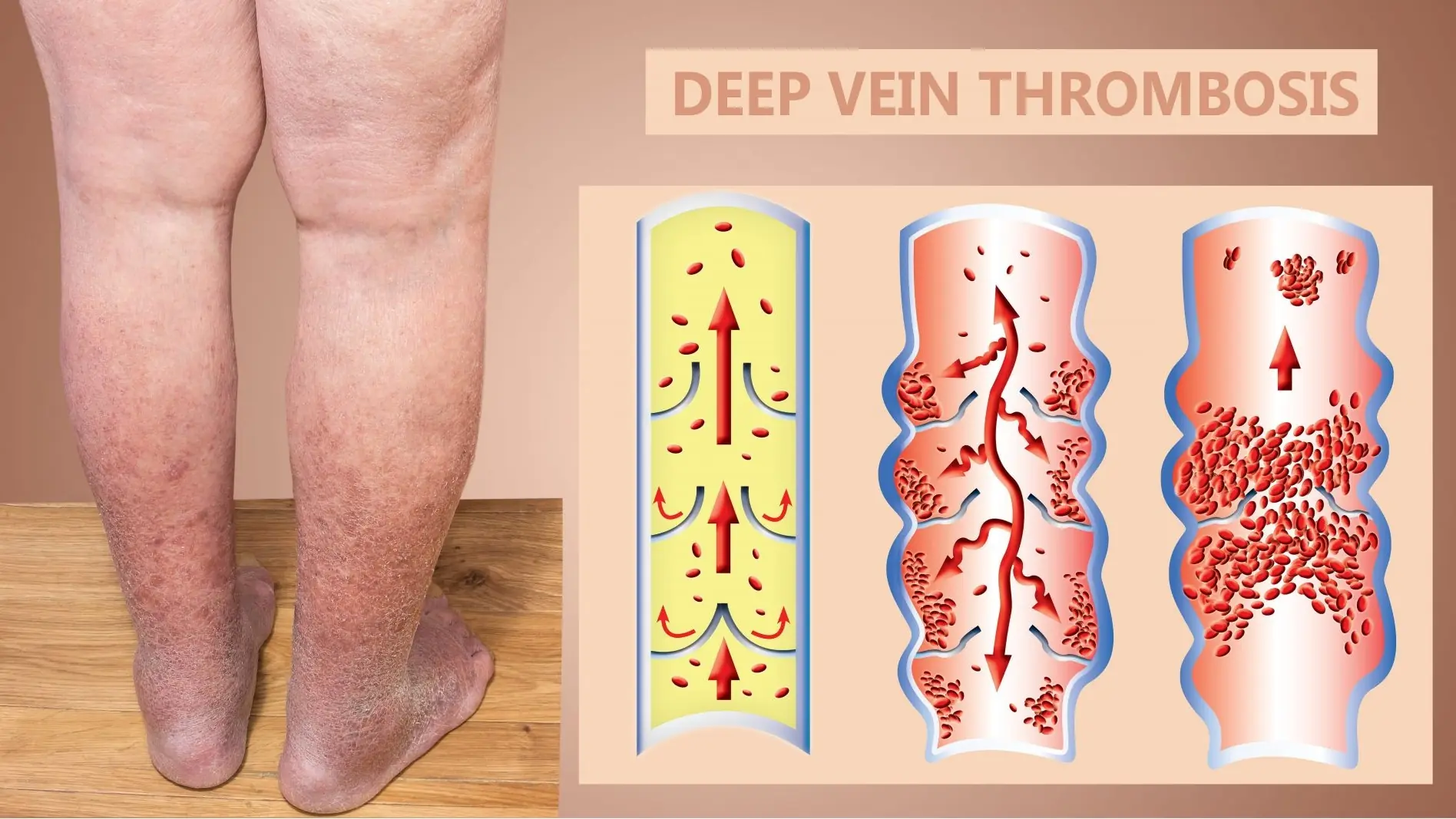 Cold feet or varicose veins? Start these 6 habits today