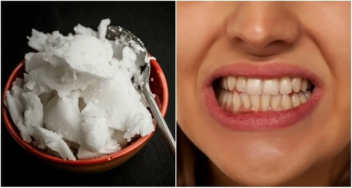 Why More People Are Using Coconut Oil as Toothpaste — And What You Should Know