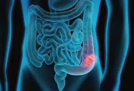 Early Detection Matters: 6 Signs of Stage 1 Colon Cancer