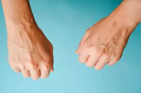 See Your Veins Easily? Here’s the Hidden Health Insight You Should Know