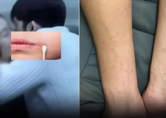 Skin Signs in Men That May In.dicate S.e.xu.ally Tran.smitted Dise.ases