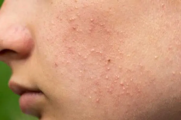 I’m dealing with tiny white bumps on my face, especially around my nose - any solutions?