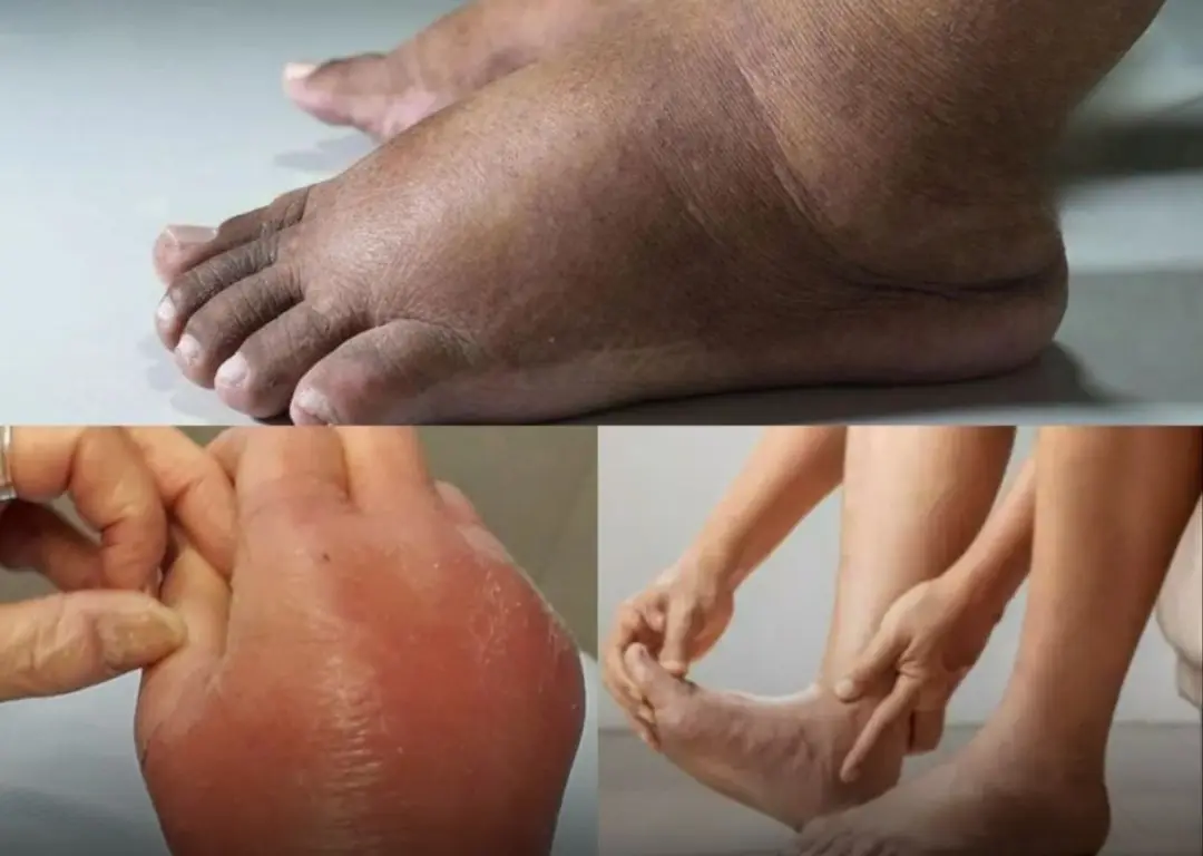 Swollen Hands and Feet? Here’s What Your Body Is Trying to Tell You