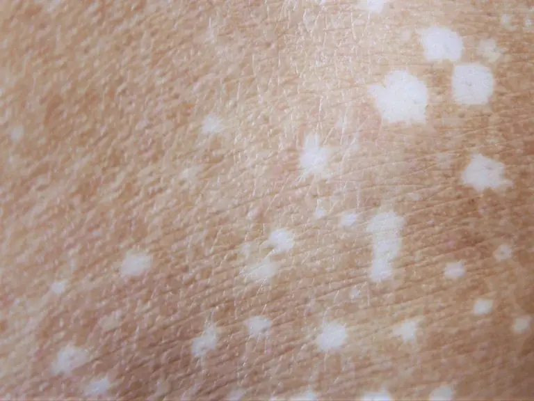 Curious about the small white spots appearing on your arms or legs?