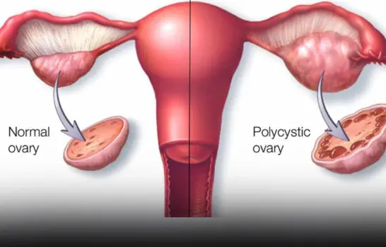 Eat 6 things to help women detoxify their ovaries and prevent gynecological diseases