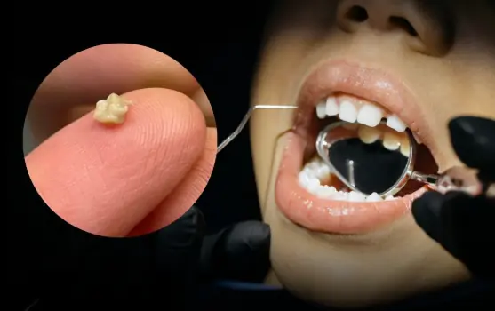 7-year-old boy mo.cked by classmates for bad smell, mother stunned by what doctor removed from his mouth