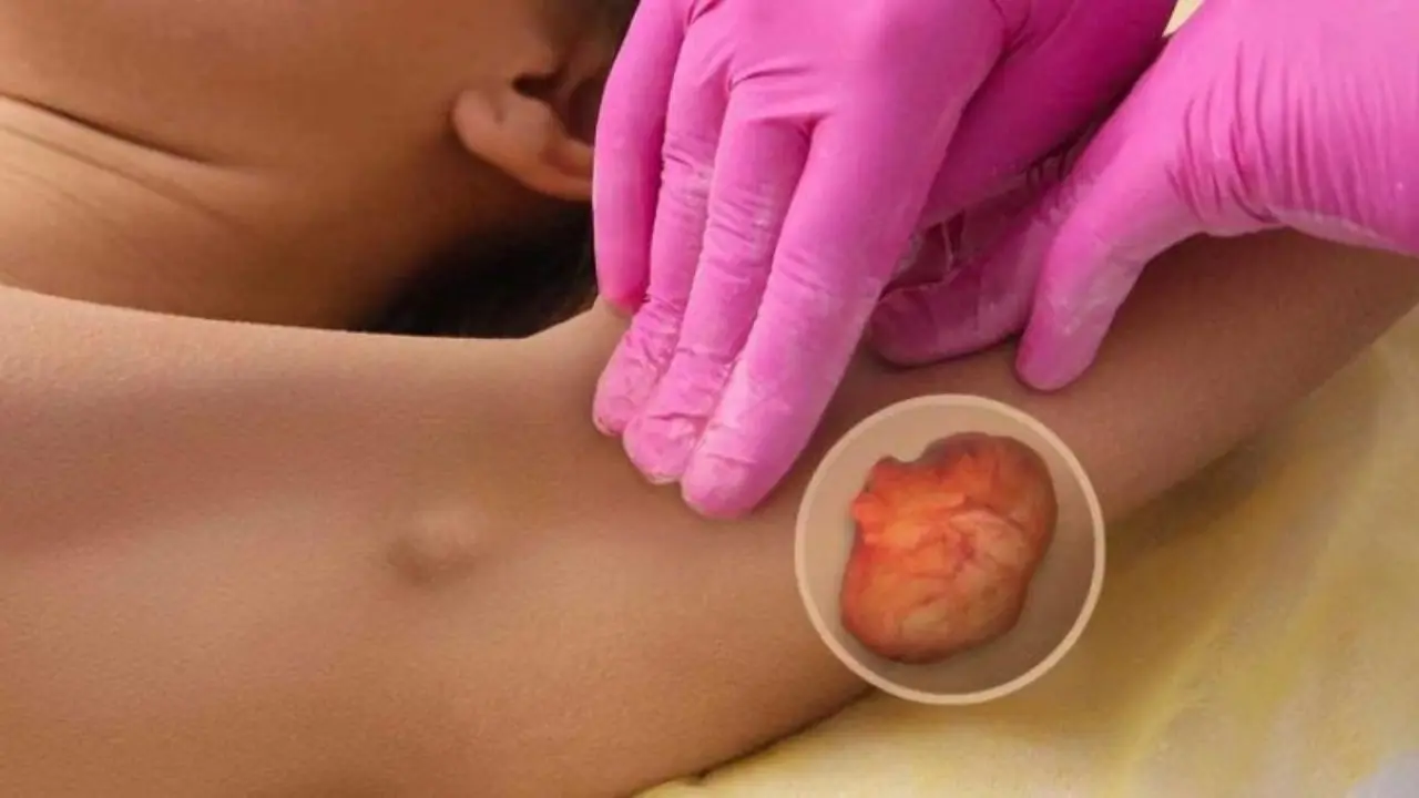 What Is a Lipoma and Should You Be Concerned? Causes and Treatments Explained