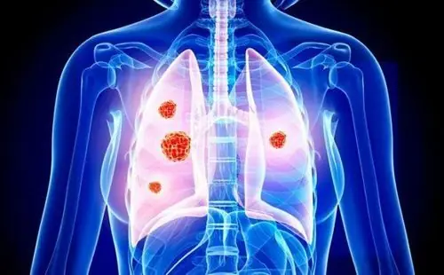 Experts Warn: These 4 Morning Symptoms May Mean Lung Cancer Is Advancing