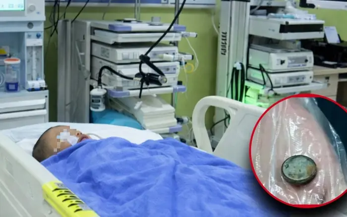 3-Year-Old Boy Swallows Button Battery: Mother Quickly Gives One Spoon of a Common Kitchen Ingredient, Doctors Praise Her Quick Thinking