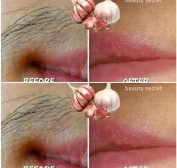 Say Goodbye to Unwanted Hair Using Garlic: Miracle Trick or Just a Myth?
