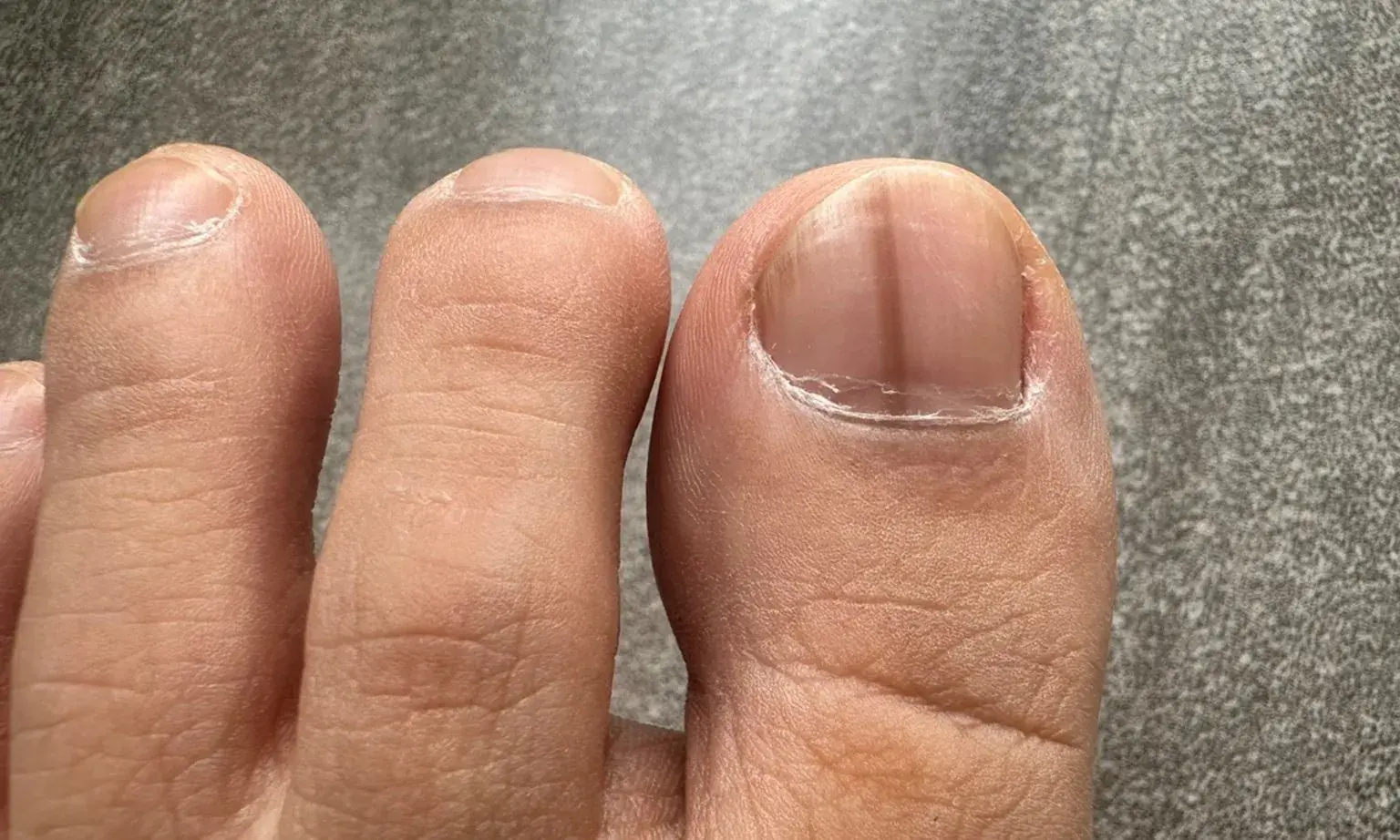 Notice lines on your nails? It may reflect underlying changes in your body