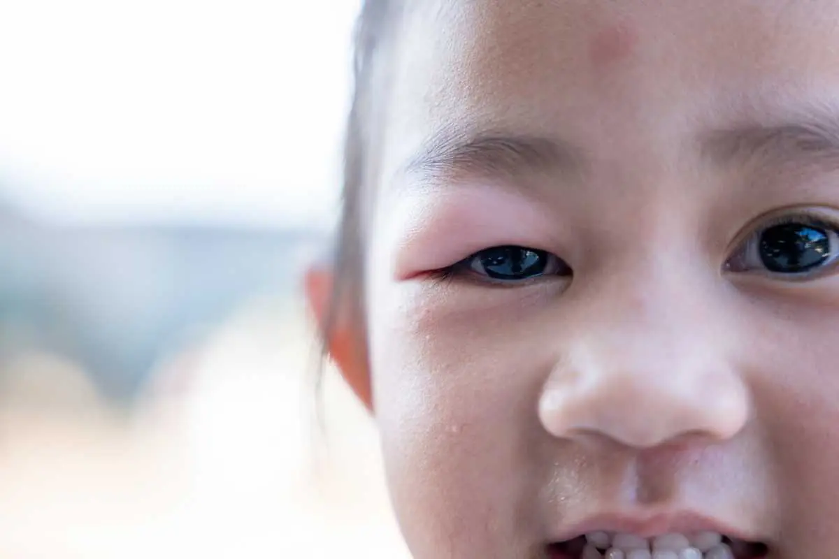 A Sudden Lump on Your Child’s Eyelid? Here’s What It Could Be—and What Parents Should Do