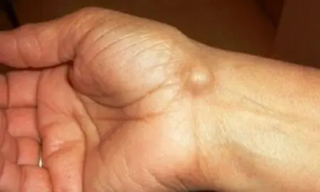 Warning: That Lump May Be Linked to a Daily Habit You Don’t Realize