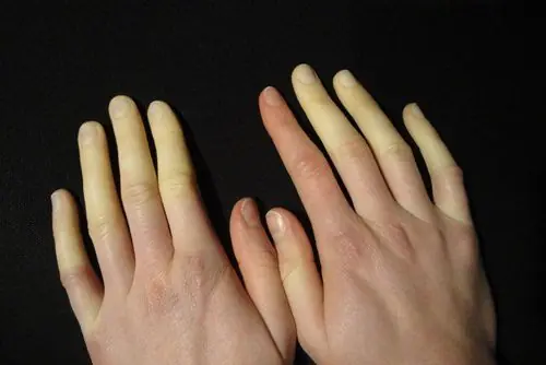 If your fingers turn white in cold weather, this is what your body may be telling you