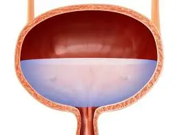 What Are the Early Signs of Bladder Cancer? Many People Miss Them