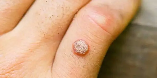 Want Clearer Skin? Try This Easy Method for Warts and Skin Tags