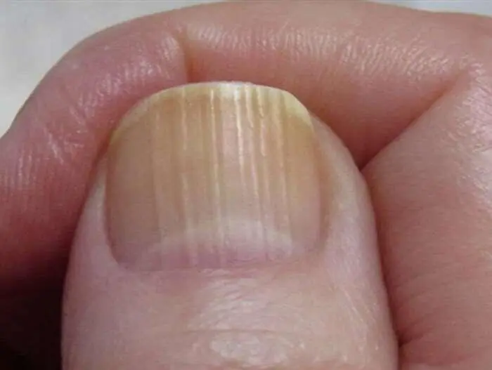 Your Nails Could Be Revealing Your Health — Here’s What Those Lines Mean