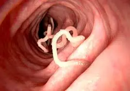 7 foods believed to help kil.l intestinal worms: Natural remedies or just myths?