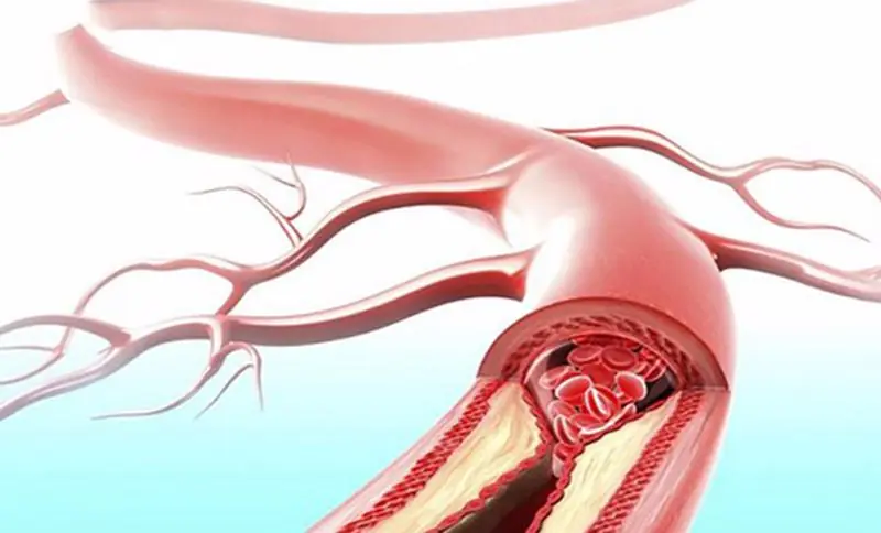 10 Signs You're Living With Clogged Arteries