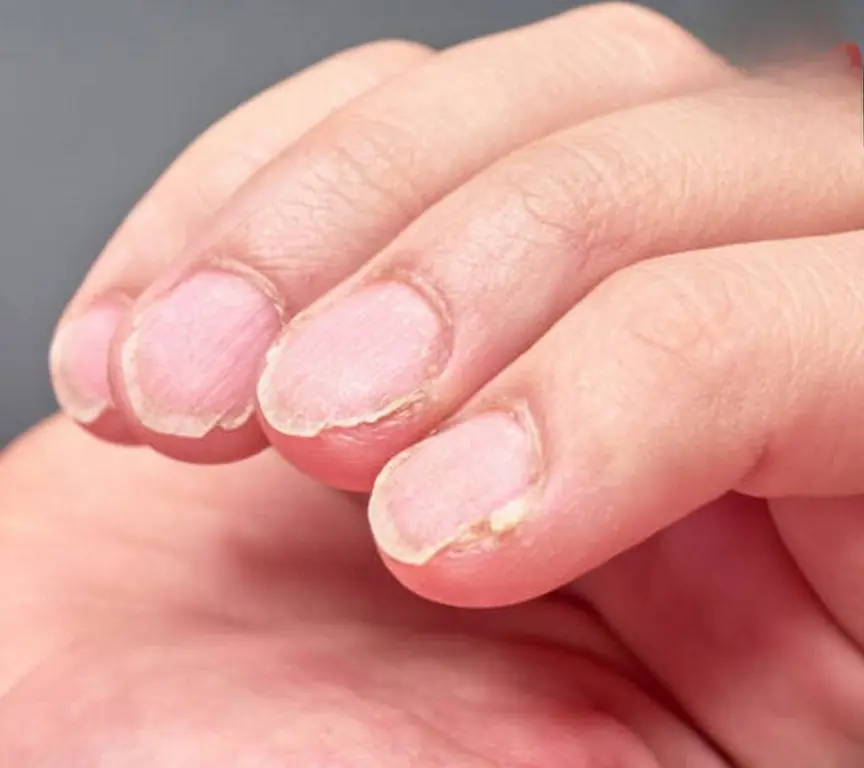 What Frequent Nail Splitting Could Be Telling You About Your Body
