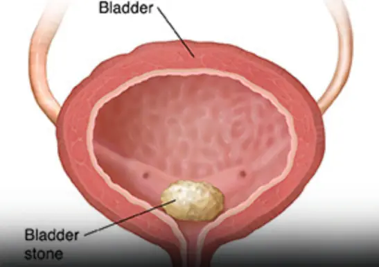 Early Warning Signs of Bladder Ca.ncer