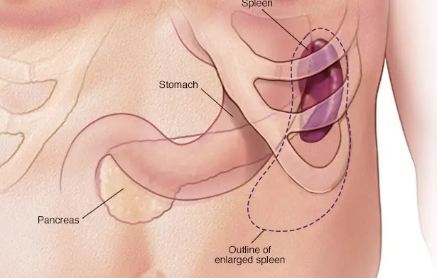 What Your Spleen May Be Telling You: Symptoms You Shouldn’t Miss