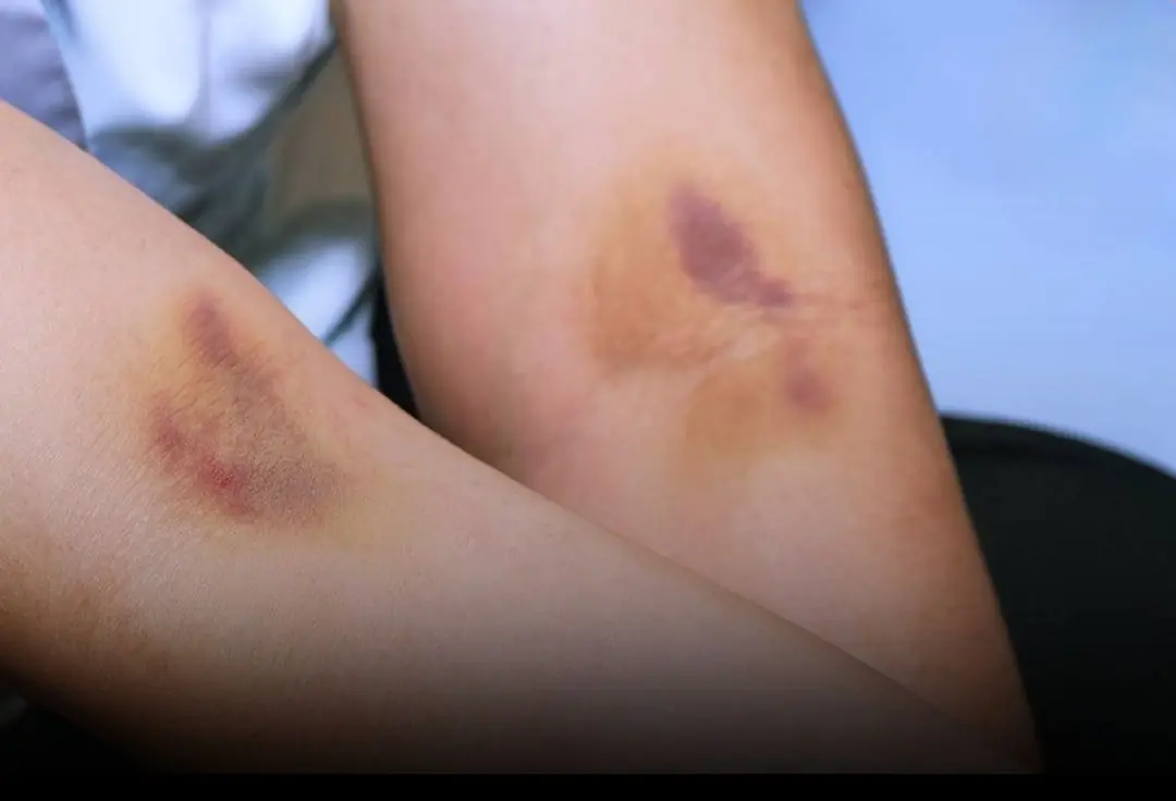 If Bruises Keep Showing Up Out of Nowhere… Your Body Might Be Trying to Tell You Something