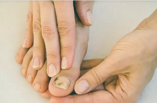 These 4 symptoms in your hands and feet could be early indicators of can.cer