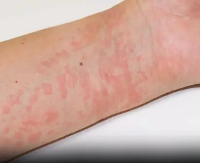 Surprising Causes Of Hives Revealed — What May Be Triggering Your Skin Reaction