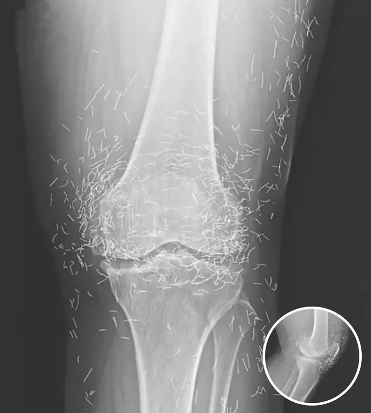 Doctors Stunned by X-Ray of Woman With Persistent Joint Pain