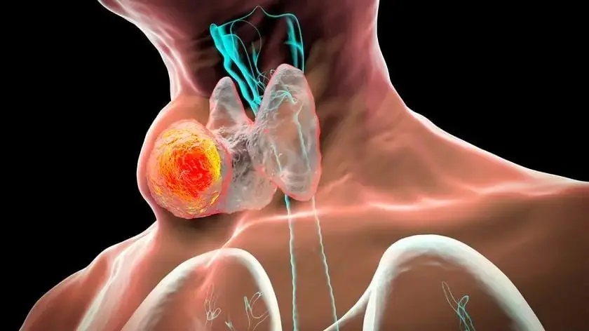 5 Signs of Late-Stage Thyroid Can.cer: The First Warning Is Often Overlooked