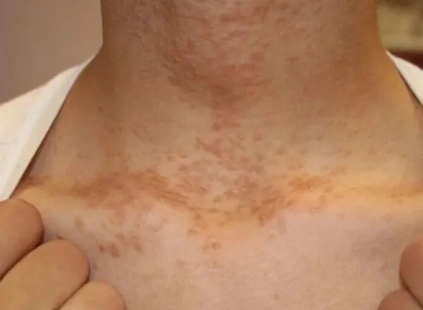 Watch for these 3 signs in the neck that could indicate a higher can.cer risk