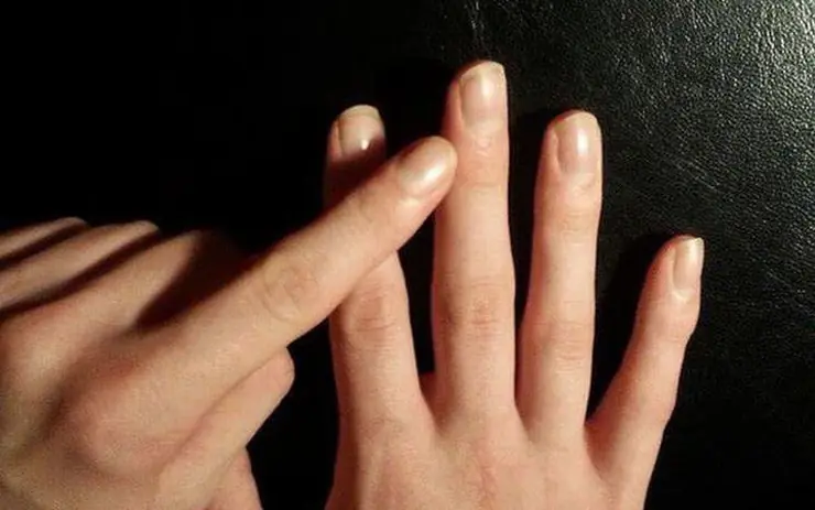 6 Finger Changes That May Be Linked to Lung Health