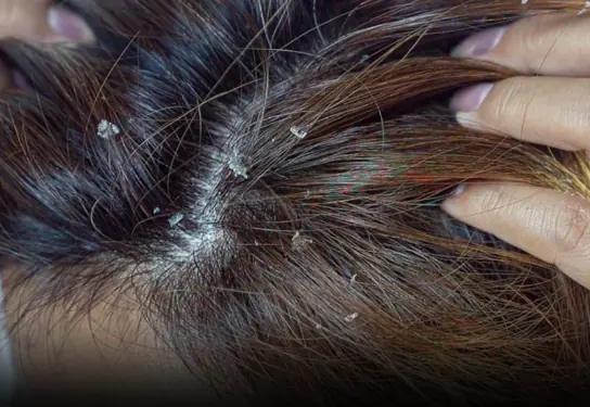 One dangerous can.cer warning sign is often mistaken for dandruff — please don’t ignore it any longer