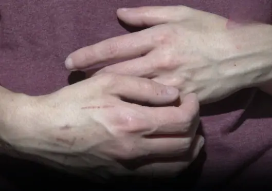 If you notice someone with prominent veins, make sure they hear this advice