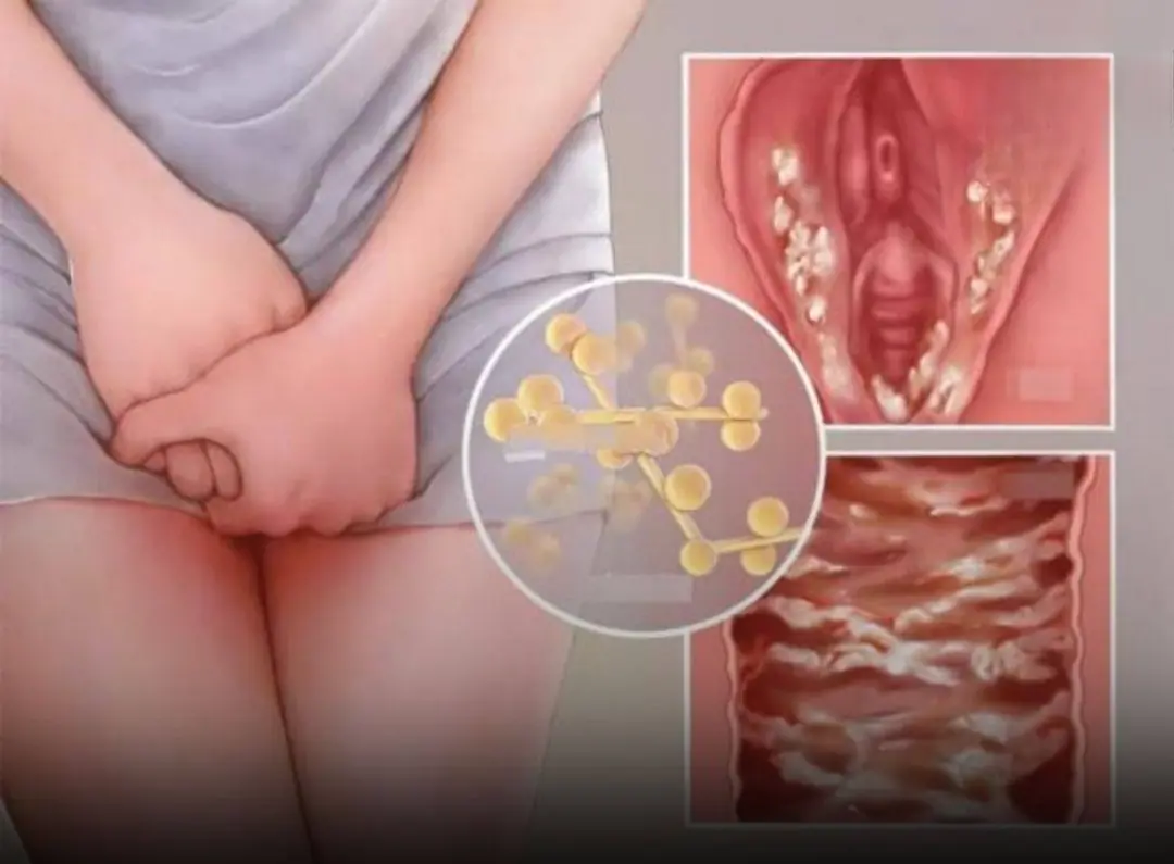 Gynecological Infections: 7 Everyday Habits You Should Change